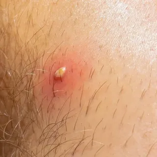 Pimple Pop⚫️✨"